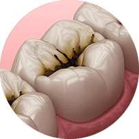 削らない痛くない虫歯治療