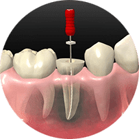 歯根管治療